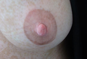vitiligo nipple